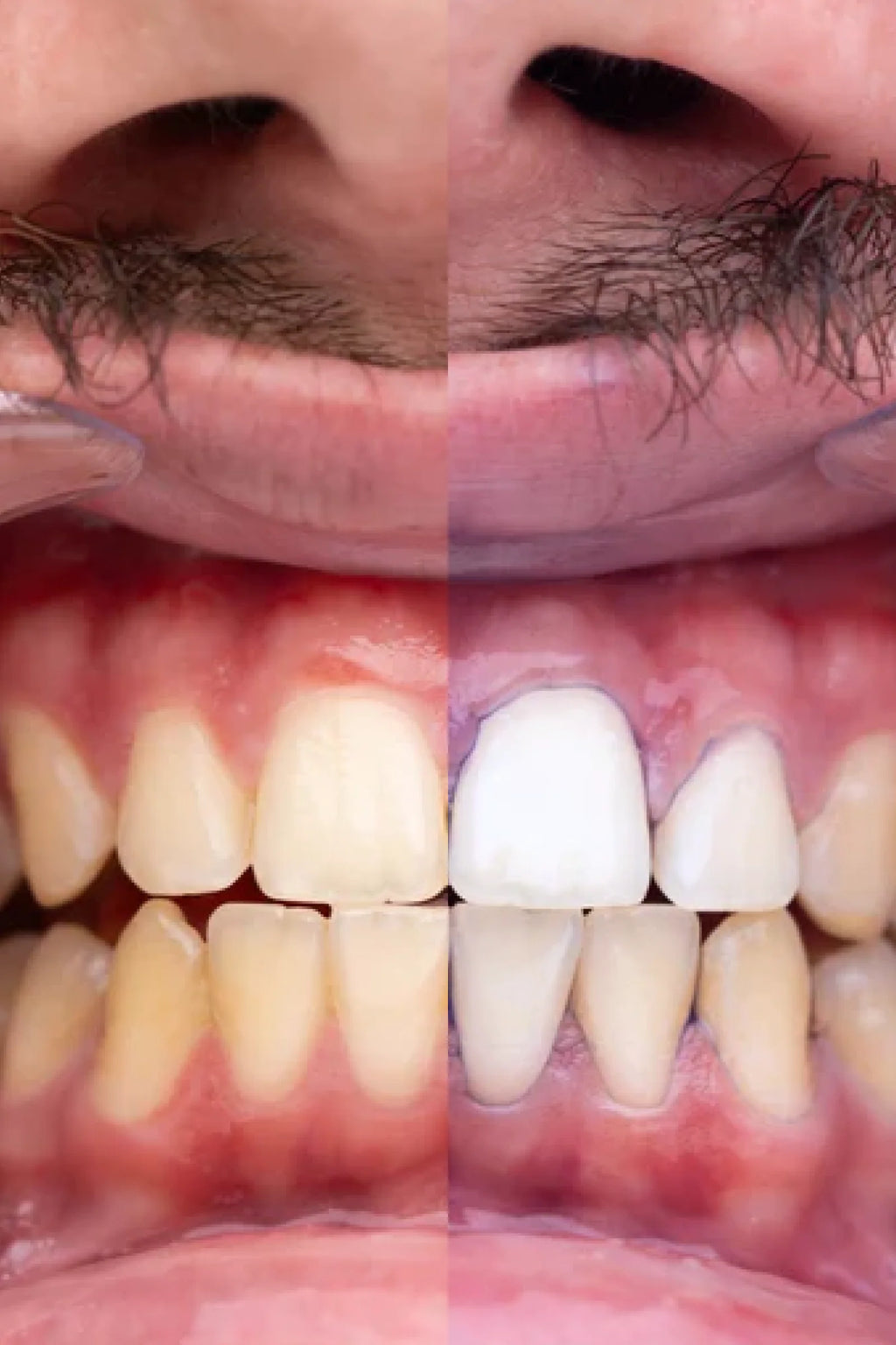 PURPLE V34 - Blanqueador Dental